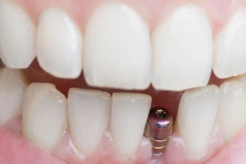Impianti dentali: tutto quello che c’è da sapere.