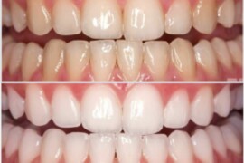 Sbiancamento Dentale: Tecniche e Considerazioni per un Sorriso Luminoso