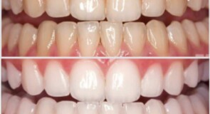 Sbiancamento Dentale: Tecniche e Considerazioni per un Sorriso Luminoso