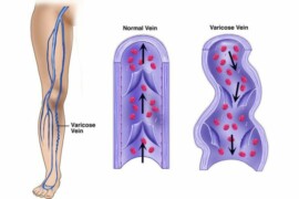 Insufficienza venosa: riconoscerla in tempo per proteggere le gambe