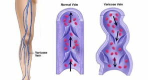 Insufficienza venosa: riconoscerla in tempo per proteggere le gambe