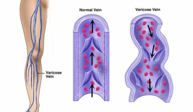 Insufficienza venosa: riconoscerla in tempo per proteggere le gambe